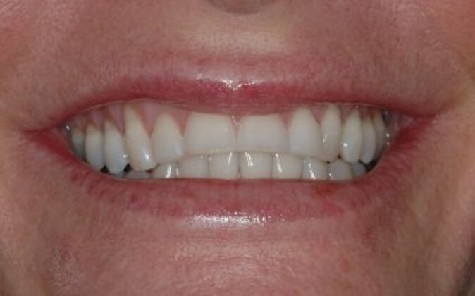 Veneers Marci - Before