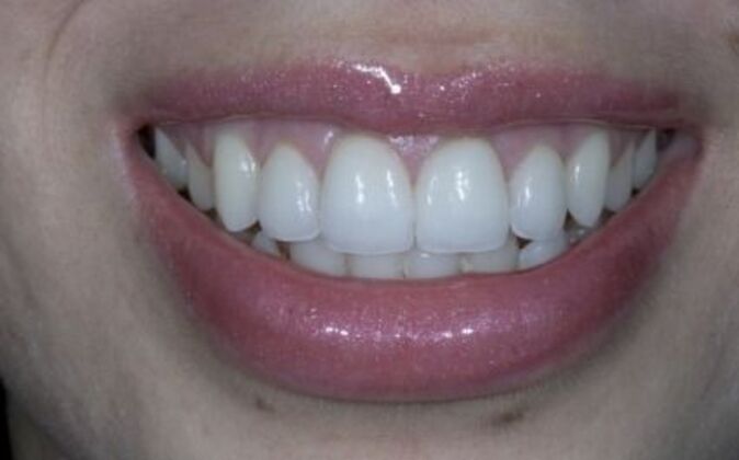 Dental Crowns Cases