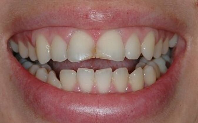 Dental Crowns  Ania - Before