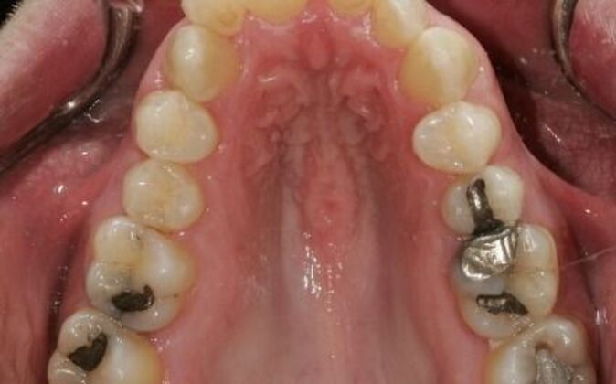 Smile Makeover: AJ - Before