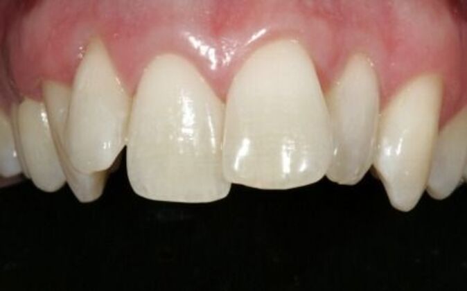 Smile Makeover: AJ - Before