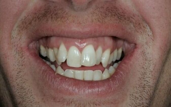 Smile Makeover AJ - Before