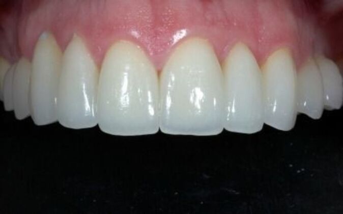 Smile Makeover: AJ - After