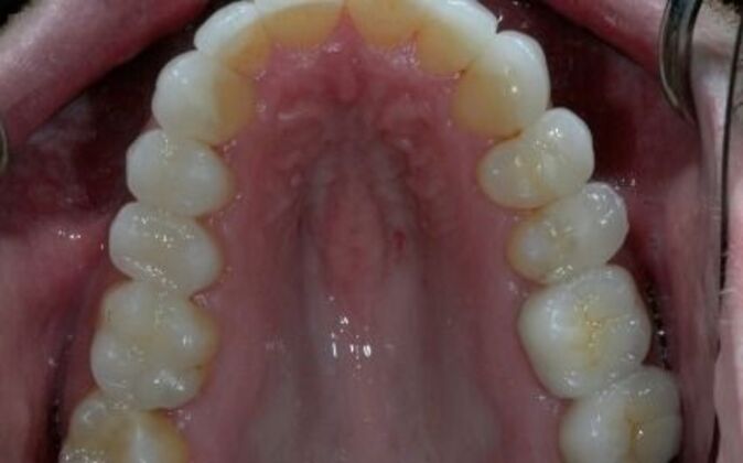 Smile Makeover: AJ - After