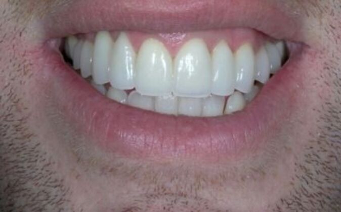 Smile Makeover AJ - After