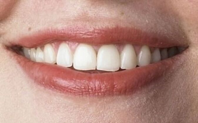 Smile Makeover Eileen - After