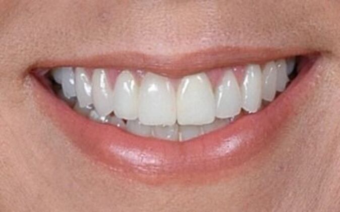 Smile Makeover KJ - After