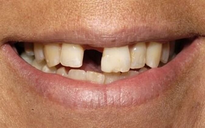 Smile Makeover KJ - Before