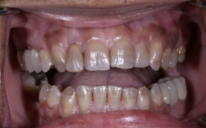Veneers Cherri - Before