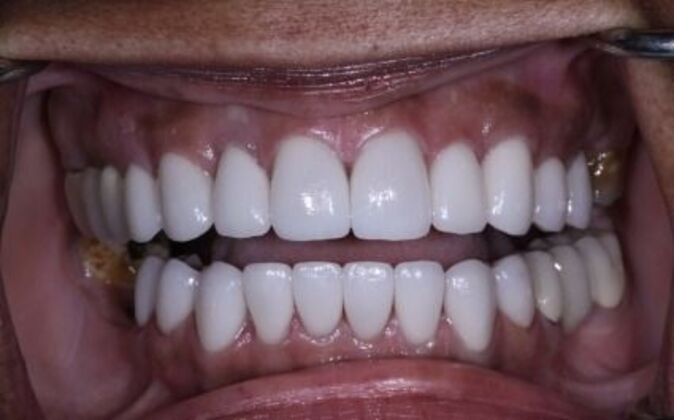 Veneers Cherri - After