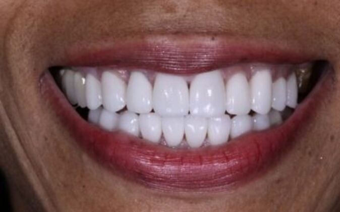 Veneers: Cherri - After