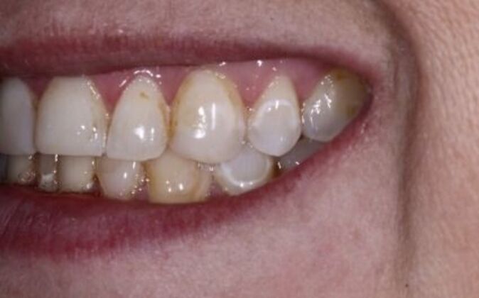 Veneers: Ann - Before