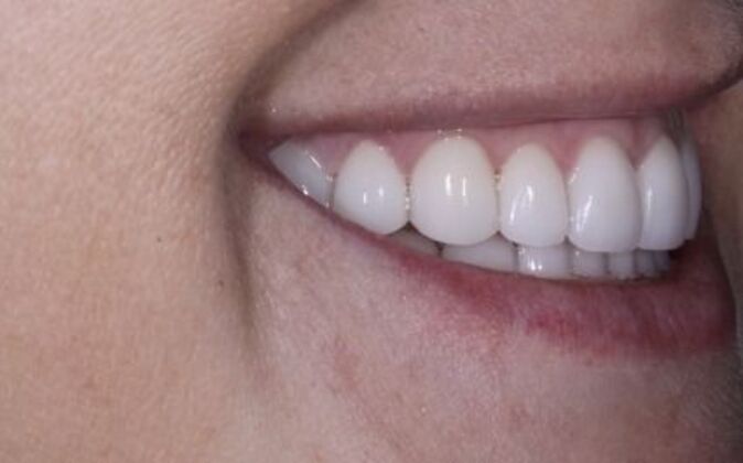 Veneers: Ann - After