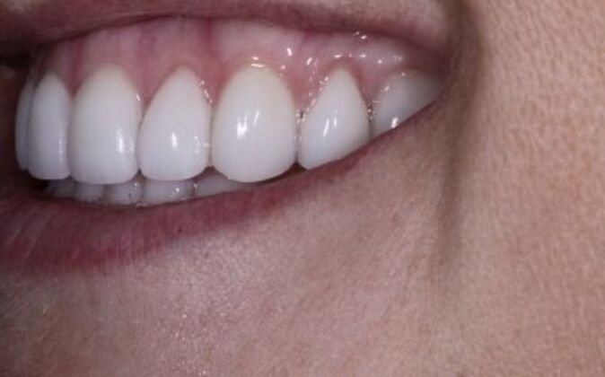 Veneers: Ann - After