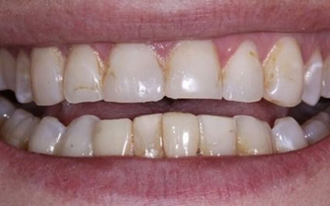 Veneers Ann - Before