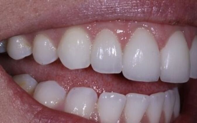 Gum Contouring: Amanda - Before