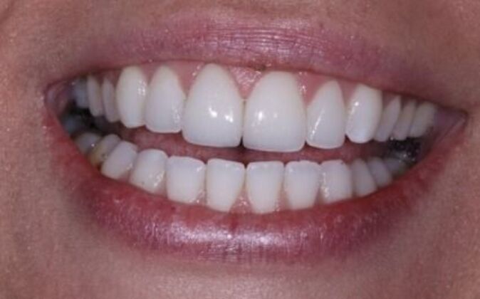 Gum Contouring Cases