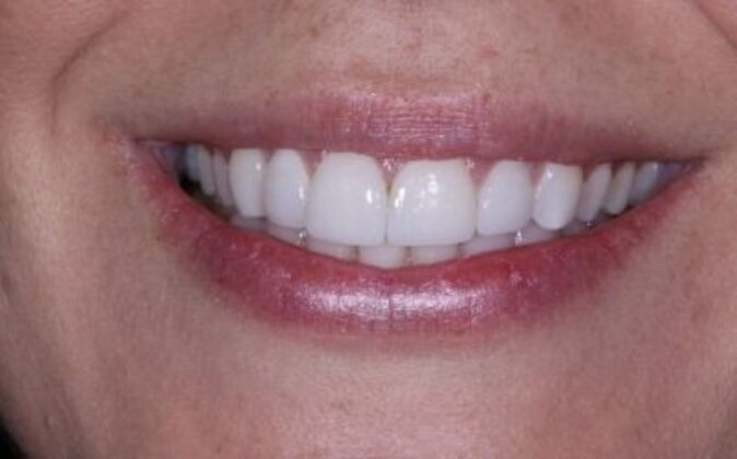 Gum Contouring Amanda - Before