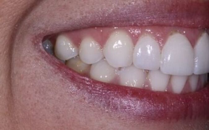 Gum Contouring: Amanda - Before