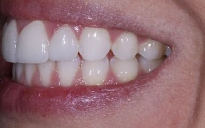 Gum Contouring: Amanda - Before