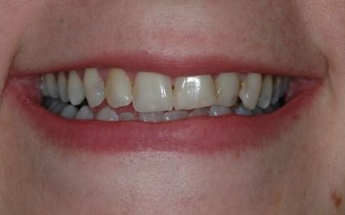 Full Mouth Reconstruction Carey - Before