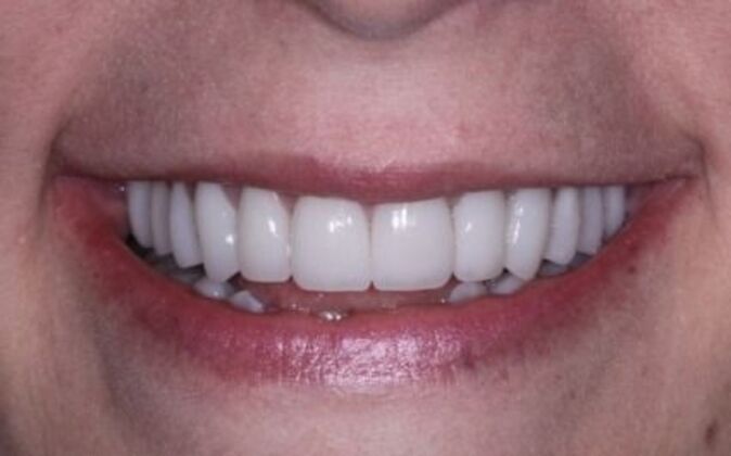 Full Mouth Reconstruction Carey - After