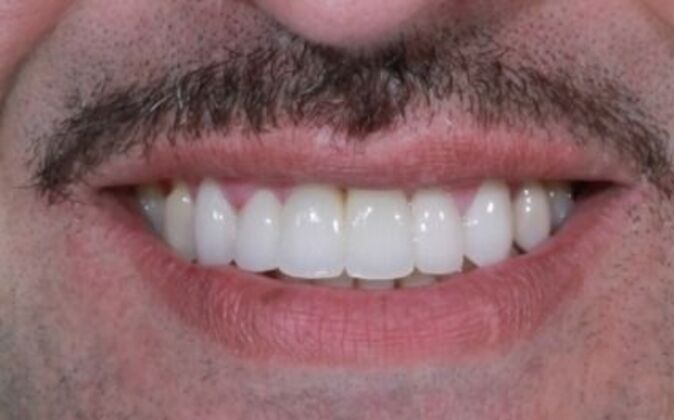 Smile Makeover Angel - After