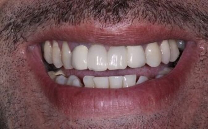 Smile Makeover Angel - Before