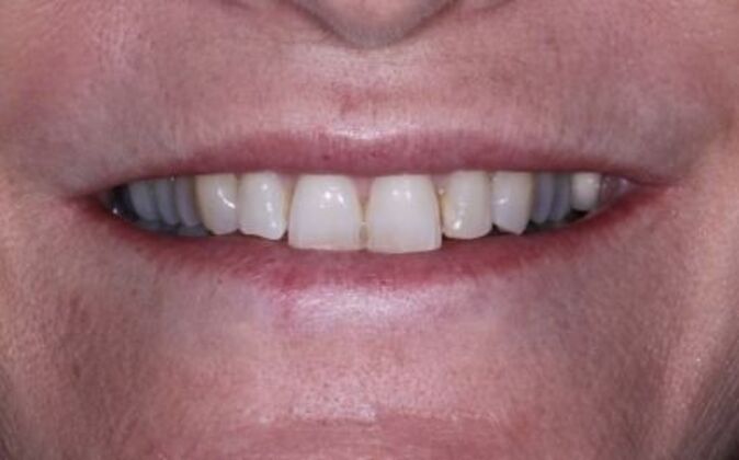 Full Mouth Reconstruction Mary - Before