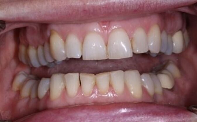 Full Mouth Reconstruction: Mary - Before