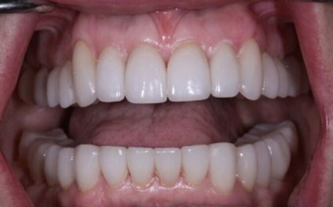 Full Mouth Reconstruction: Mary - After