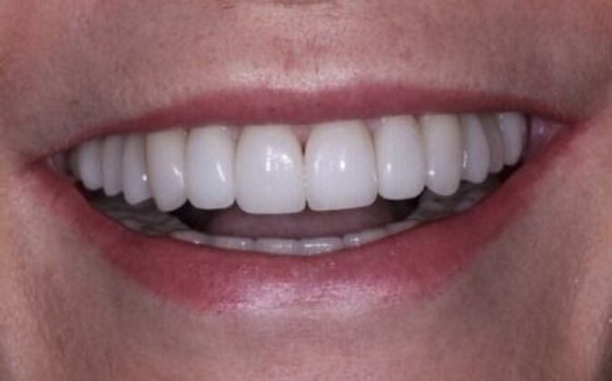 Full Mouth Reconstruction Mary - After