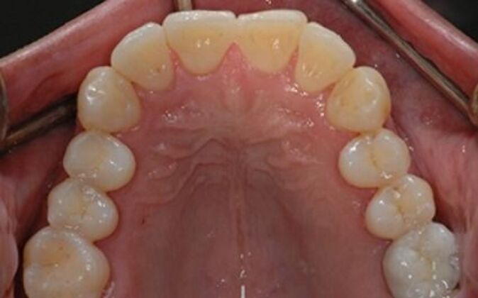 Full Mouth Reconstruction: Joe - After