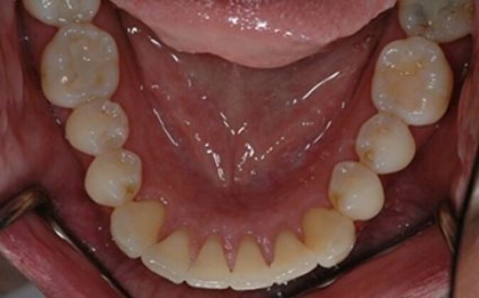 Full Mouth Reconstruction Joe - After