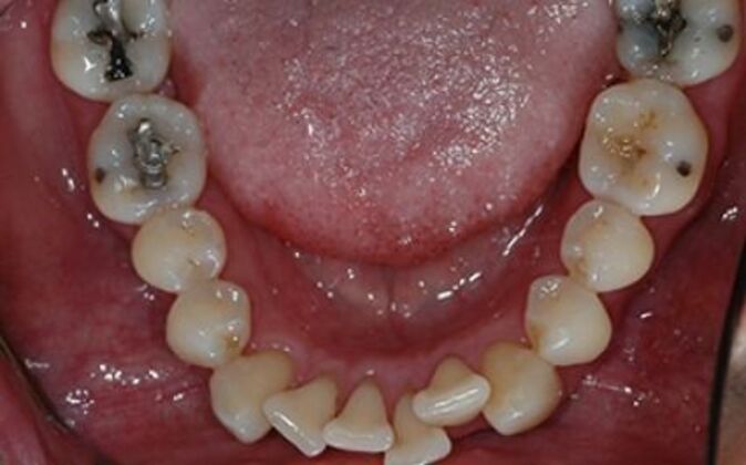 Full Mouth Reconstruction Joe - Before