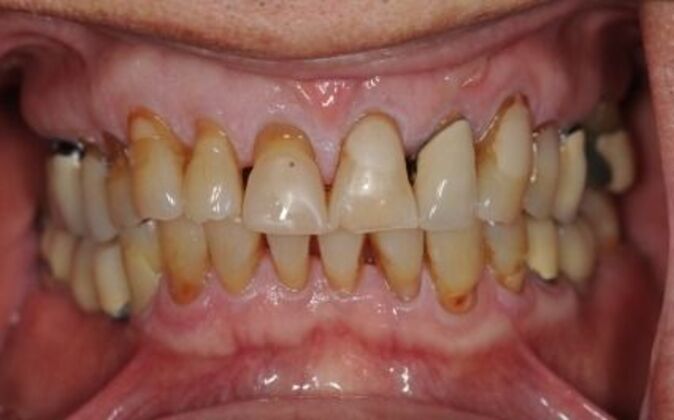 Full Mouth Reconstruction Joe 2 - Before