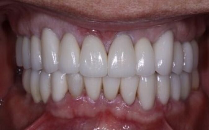 Full Mouth Reconstruction Joe 2 - After