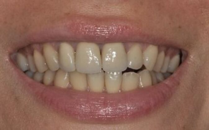 Veneers Ruxandra - Before