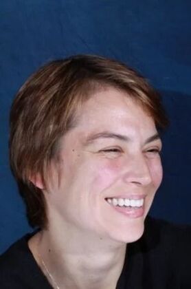 Veneers: Ruxandra - After