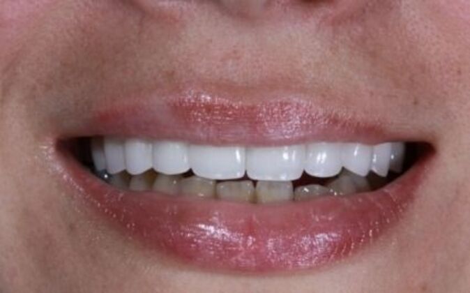 Veneers Ruxandra - After