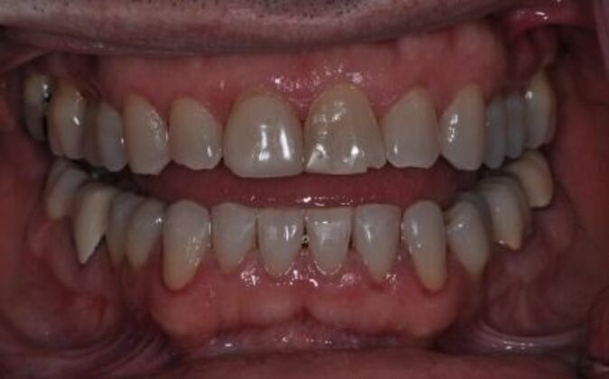 Smile Makeover Joe - Before