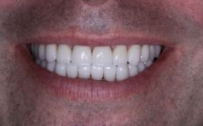 Smile Makeover: Joe - After