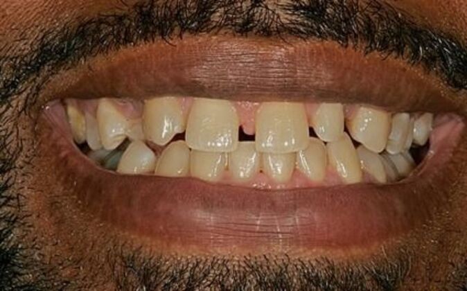 Veneers Jon - Before