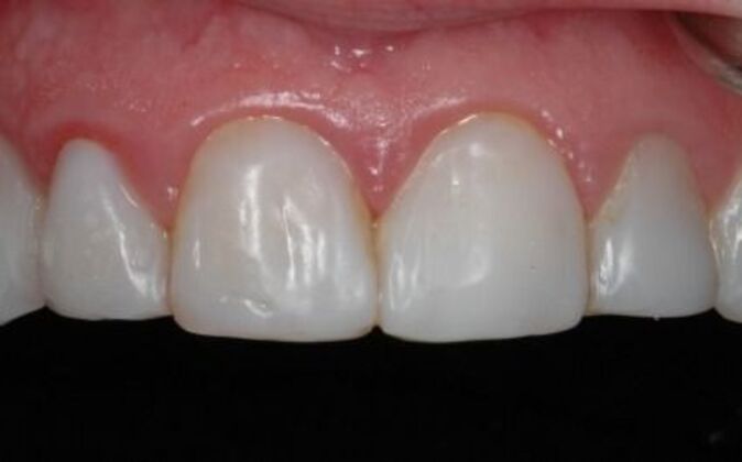 Smile Makeover: Ashlea - Before