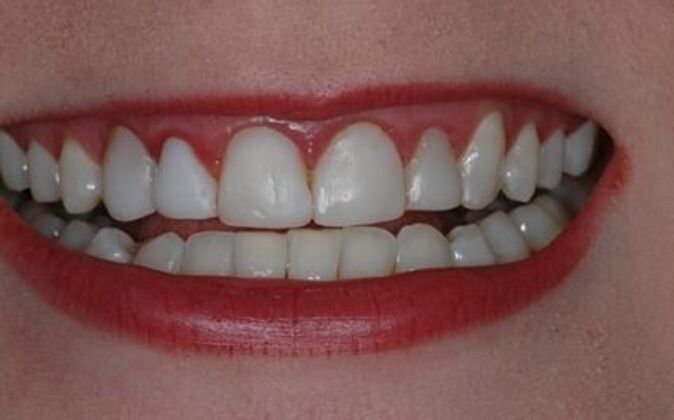 Smile Makeover Ashlea - Before