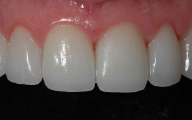 Smile Makeover: Ashlea - After