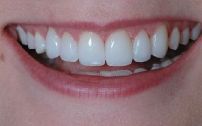 Smile Makeover Ashlea - After