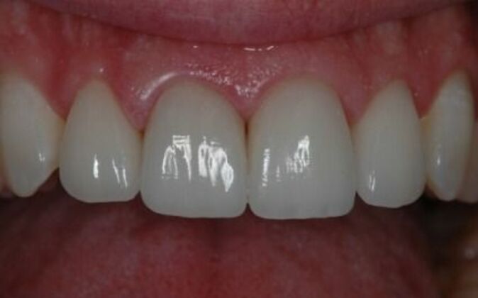 Gum Contouring Dennis - After