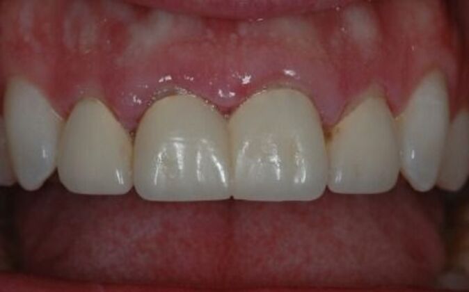 Gum Contouring Dennis - Before