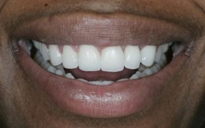 Smile Makeover Stacy - After